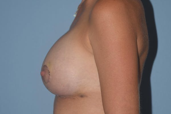 Breast Augmentation Lift Before & After Gallery - Patient 16480559 - Image 10