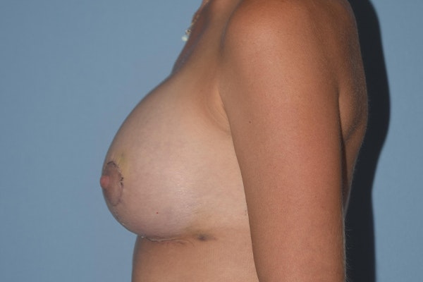 Breast Augmentation Lift Before & After Gallery - Patient 16480559 - Image 10