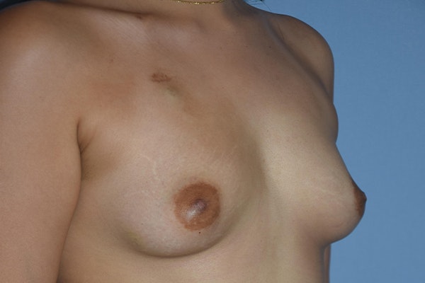Breast Reconstruction Before & After Gallery - Patient 16486406 - Image 3