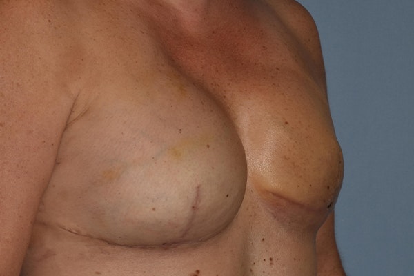 Breast Reconstruction Before & After Gallery - Patient 16486407 - Image 4
