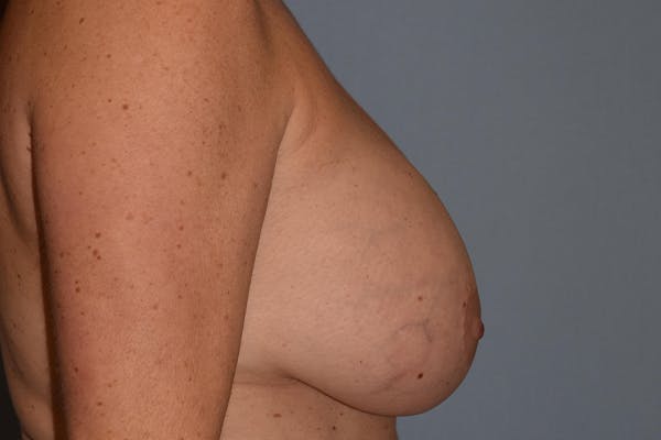 Breast Reconstruction Before & After Gallery - Patient 16486407 - Image 5