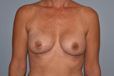 Breast Reconstruction Before & After Gallery - Patient 16486408 - Image 2