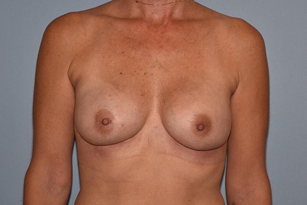 Breast Reconstruction Before & After Gallery - Patient 16486408 - Image 2