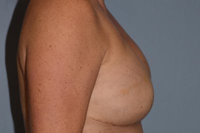 Breast Reconstruction Before & After Gallery - Patient 16486407 - Image 6