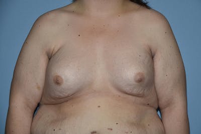 Breast Reconstruction Before & After Gallery - Patient 16486409 - Image 1