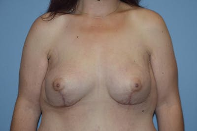 Breast Reconstruction Before & After Gallery - Patient 16486409 - Image 2