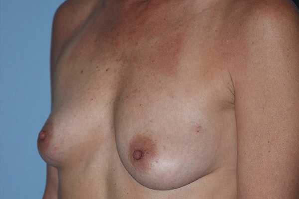 Breast Reconstruction Before & After Gallery - Patient 16486408 - Image 5