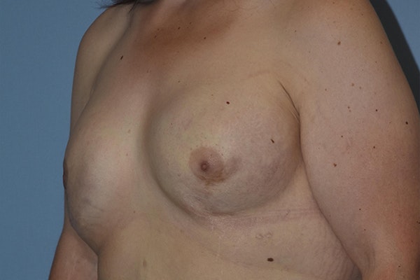 Breast Reconstruction Before & After Gallery - Patient 16486409 - Image 3