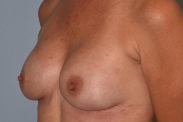 Breast Reconstruction Before & After Gallery - Patient 16486408 - Image 6