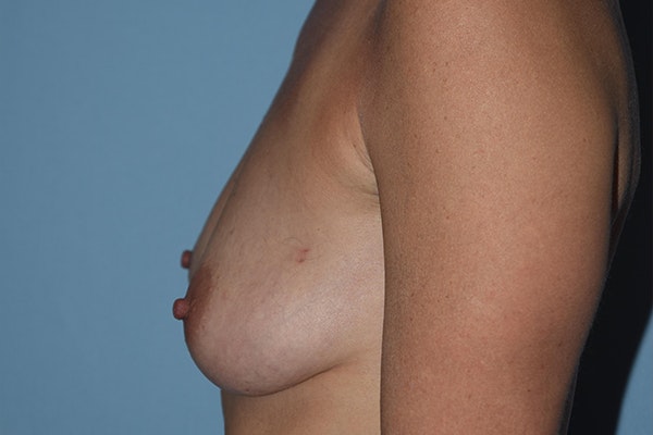 Breast Reconstruction Before & After Gallery - Patient 16486408 - Image 7