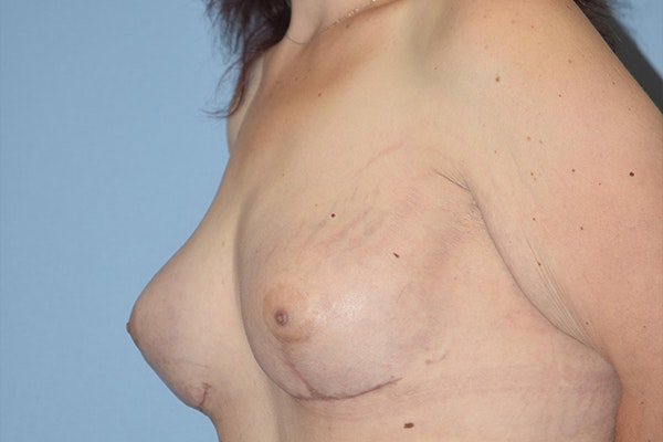 Breast Reconstruction Before & After Gallery - Patient 16486409 - Image 4