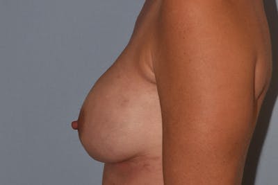 Breast Reconstruction Before & After Gallery - Patient 16486408 - Image 8