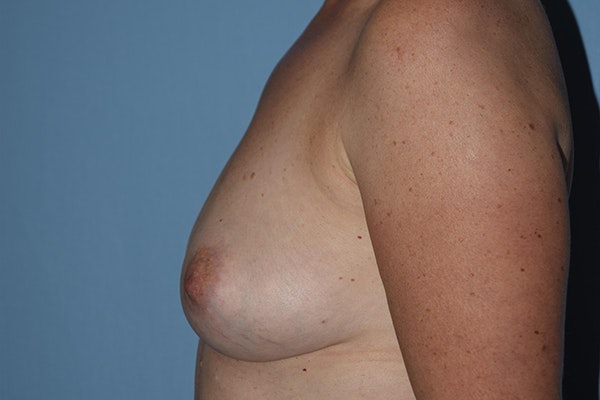 Breast Reconstruction Before & After Gallery - Patient 16486410 - Image 5