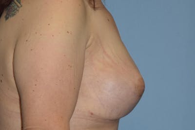 Breast Reconstruction Before & After Gallery - Patient 16486409 - Image 8
