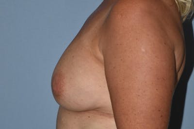 Breast Reconstruction Before & After Gallery - Patient 16486410 - Image 6