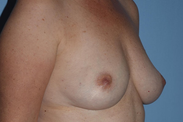 Breast Reconstruction Before & After Gallery - Patient 16486410 - Image 7