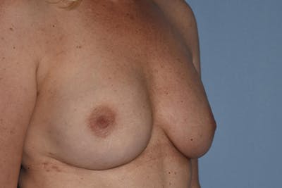 Breast Reconstruction Before & After Gallery - Patient 16486410 - Image 8