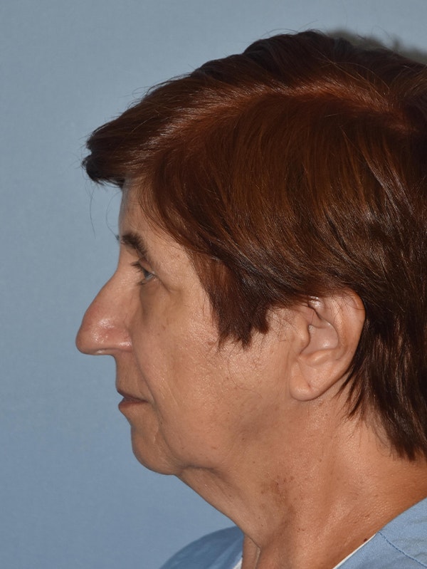 Facelift Before & After Gallery - Patient 16486823 - Image 5