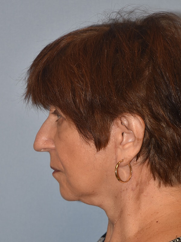 Facelift Before & After Gallery - Patient 16486823 - Image 6