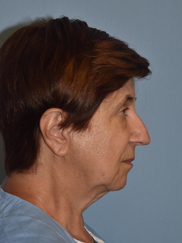 Facelift Before & After Gallery - Patient 16486823 - Image 9