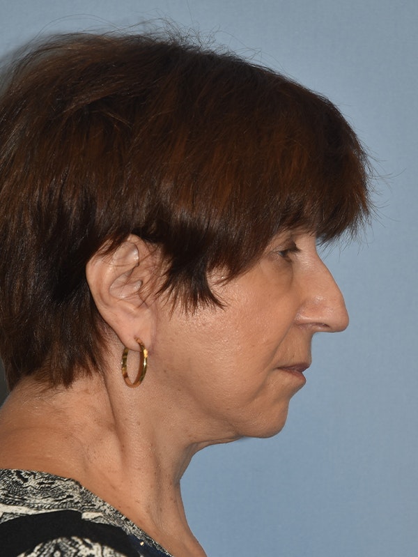 Facelift Before & After Gallery - Patient 16486823 - Image 10