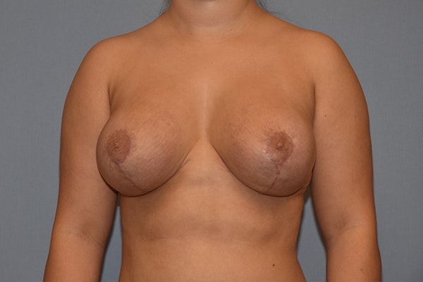 Breast Augmentation Lift Before & After Gallery - Patient 16509769 - Image 2