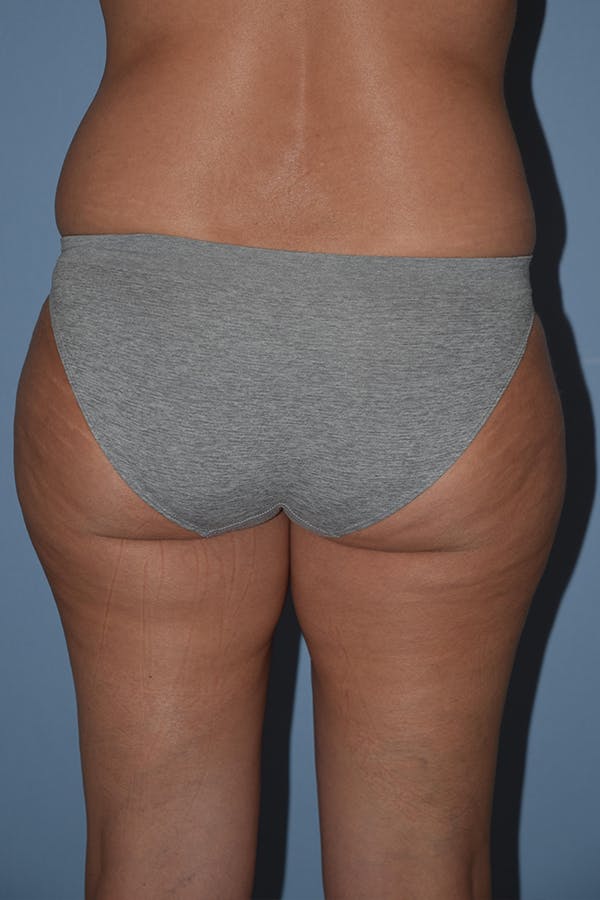 Liposuction Before & After Gallery - Patient 16555406 - Image 3