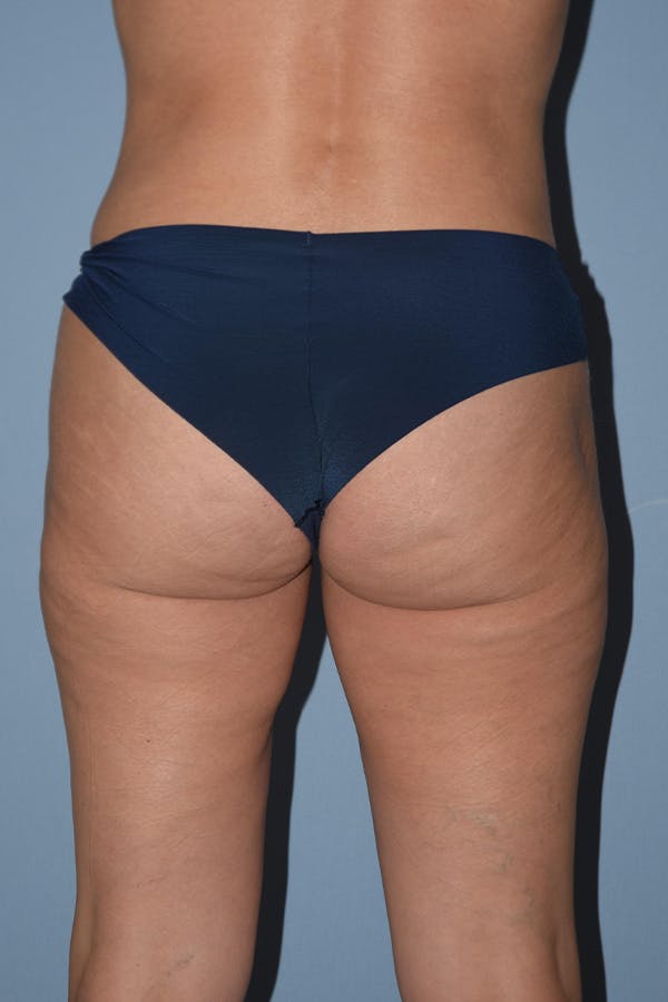 Liposuction Before & After Gallery - Patient 16555406 - Image 4
