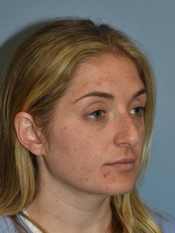 Rhinoplasty Before & After Gallery - Patient 17229562 - Image 5