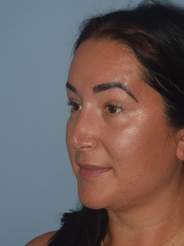 Rhinoplasty Before & After Gallery - Patient 17229563 - Image 5