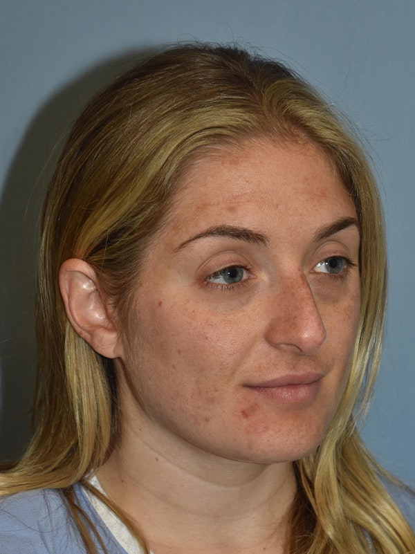 Rhinoplasty Before & After Gallery - Patient 17229562 - Image 7