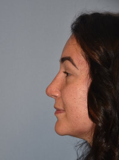 Rhinoplasty Before & After Gallery - Patient 17229563 - Image 8