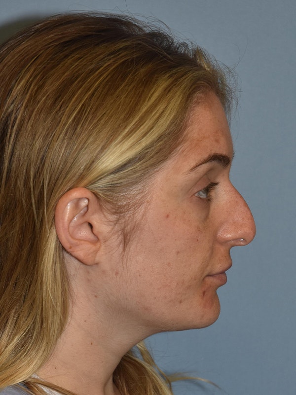 Rhinoplasty Before & After Gallery - Patient 17229562 - Image 1