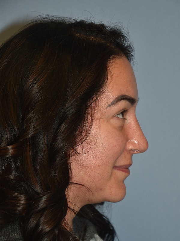 Rhinoplasty Before & After Gallery - Patient 17229563 - Image 1