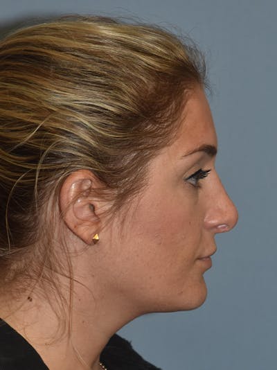 Rhinoplasty Before & After Gallery - Patient 17229562 - Image 2