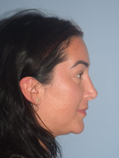 Rhinoplasty Before & After Gallery - Patient 17229563 - Image 2