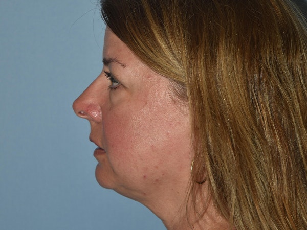 Facial Fat Grafting Before & After Gallery - Patient 17337871 - Image 5