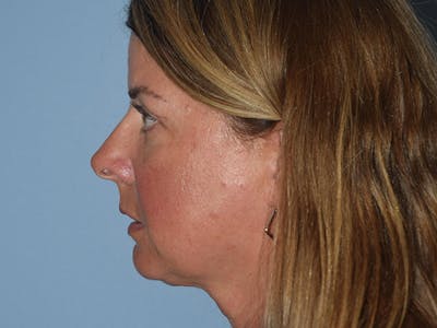 Facial Fat Grafting Before & After Gallery - Patient 17337871 - Image 6