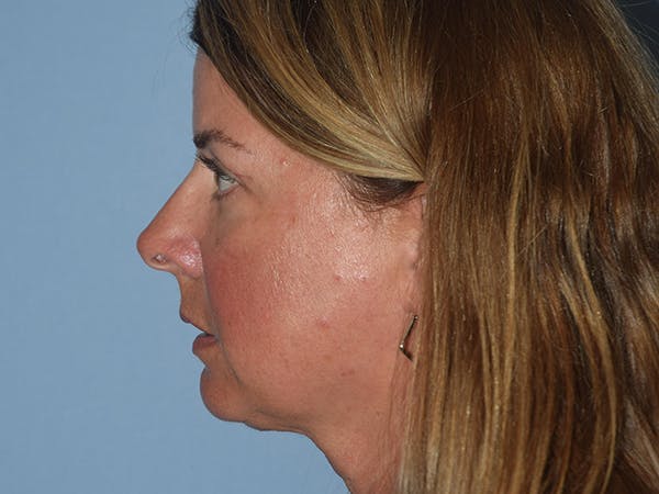 Facial Fat Grafting Gallery - Patient 17337871 - Image 6