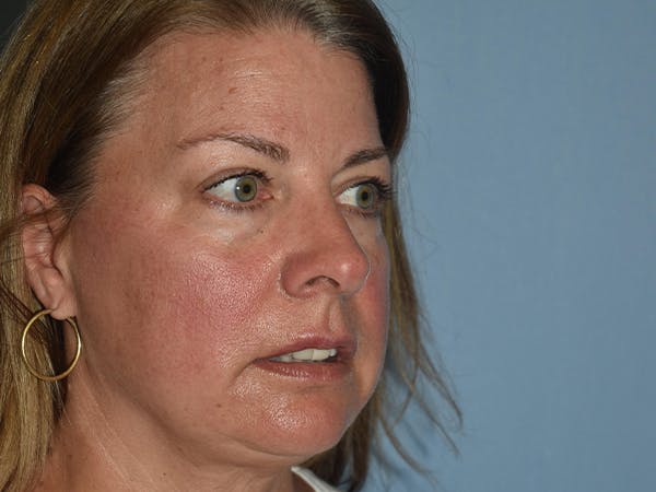 Facial Fat Grafting Gallery - Patient 17337871 - Image 7