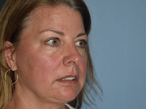 Facial Fat Grafting Before & After Gallery - Patient 17337871 - Image 7
