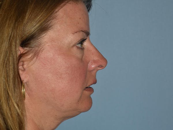 Facial Fat Grafting Gallery - Patient 17337871 - Image 9