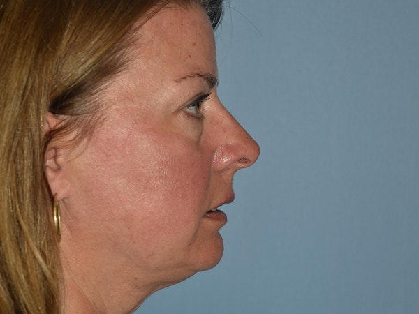 Facial Fat Grafting Before & After Gallery - Patient 17337871 - Image 9