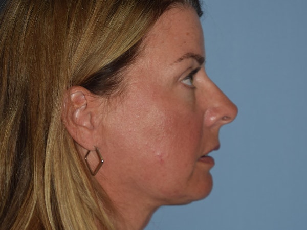 Facial Fat Grafting Before & After Gallery - Patient 17337871 - Image 10