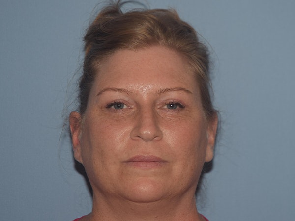 Facial Fat Grafting Before & After Gallery - Patient 17337872 - Image 2