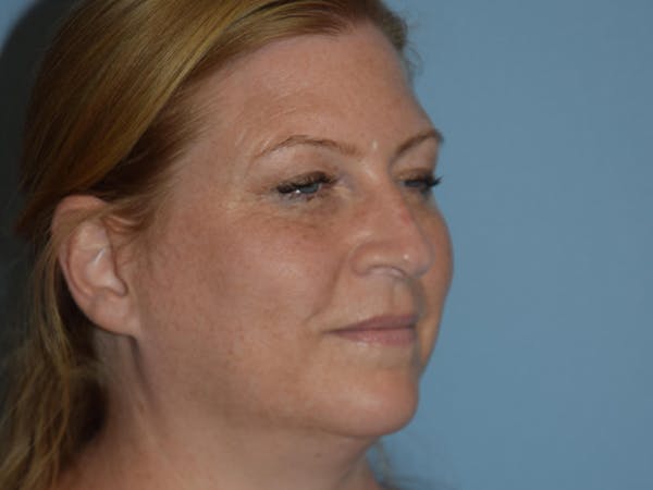 Facial Fat Grafting Gallery - Patient 17337872 - Image 3