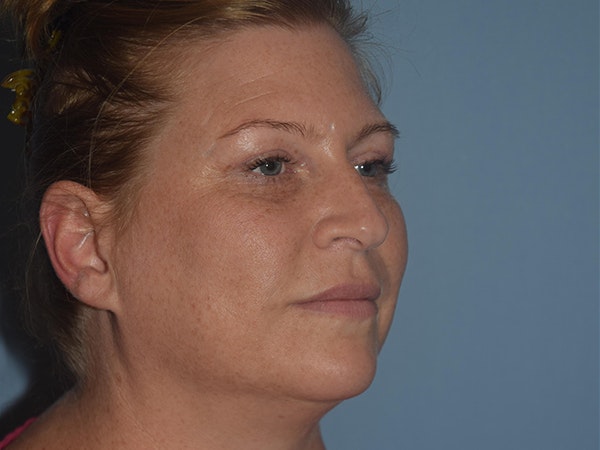 Facial Fat Grafting Before & After Gallery - Patient 17337872 - Image 4