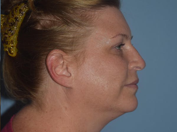 Facial Fat Grafting Gallery - Patient 17337872 - Image 6