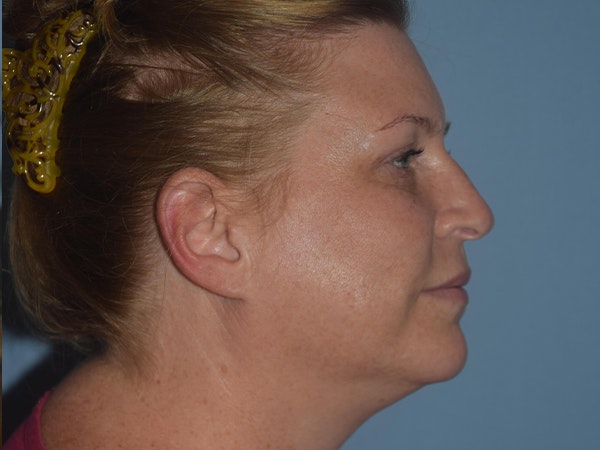 Facial Fat Grafting Before & After Gallery - Patient 17337872 - Image 6