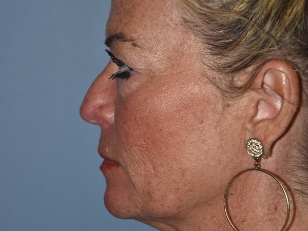Facial Fat Grafting Before & After Gallery - Patient 17337873 - Image 5